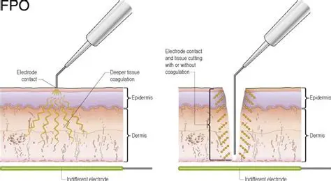 Curettage and Electrodesiccation