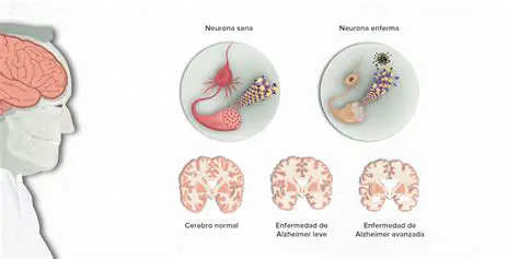 La Enfermedad de Alzheimer