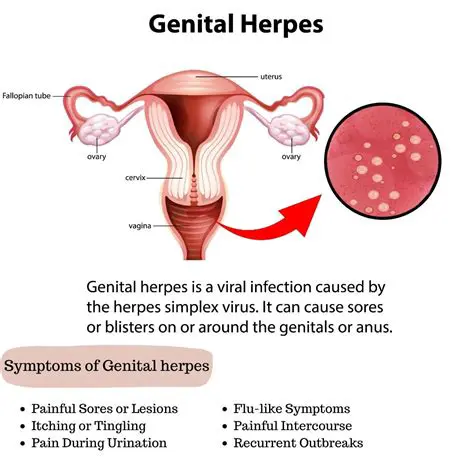 Symptoms of Genital Herpes