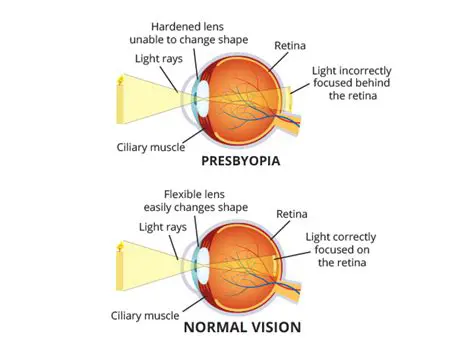 The Literal Meaning of Presbyopia